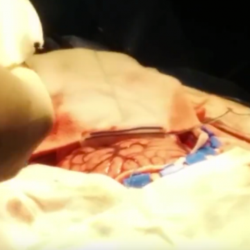 Cerebro latiendo justo antes de una operación | www.perestupinya.com